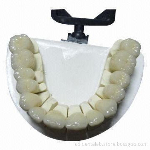 Zirconia Bridge, Ideal Solution for Posteriors Instead of PFM Metal Occlusals or Full Metal Crowns